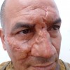 Prosthetics 19 of 54